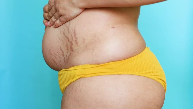 Side view of unrecognizable fat woman wearing yellow bikini, lifting excess flabby stomach, showing stretch marks on blue background. Body positive, obesity, weight loss, liposuction, unhealthy diet.