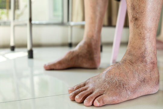 Closeup of foot,old elderly with swollen leg,dry skin of feet,cracks on the skin,lack of moisture,senior patient with beriberi,numbness of the toes,skin care problems,medical and health care concept