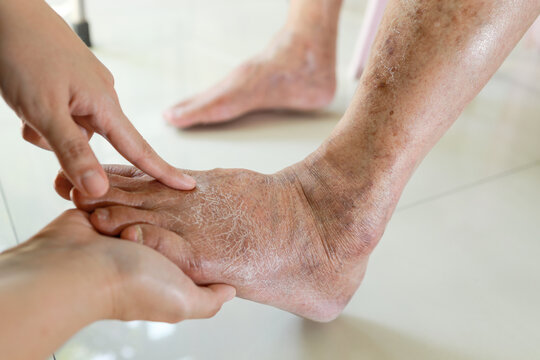 Hands of doctor or nurse examining the dry,cracked,swollen feet of old elderly people,skin care problems,senior woman with diabetes or kidney disease causing swollen legs,health care,medical concept