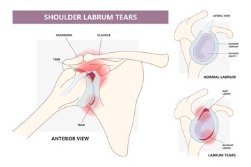 Bankart lesion slap tear bony hill sachs torn bone periosteal pain humerus cuff tendon aching range of motion arm Arthroscopy dislocated frozen trauma cavity disease inferior repair rim humeral