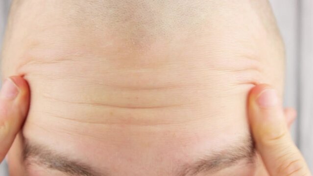 Wrinkles on the forehead of a man close-up. Man's head wrinkles.