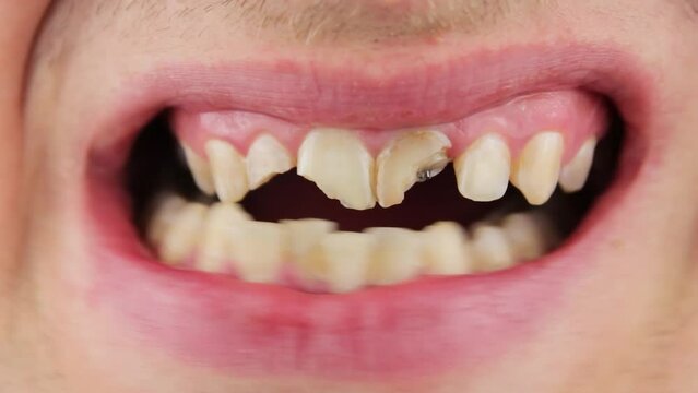 Broken teeth of a man close-up. Broken tooth enamel.