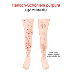 Henoch-Schönlein purpura. Spotty rash on the humans legs