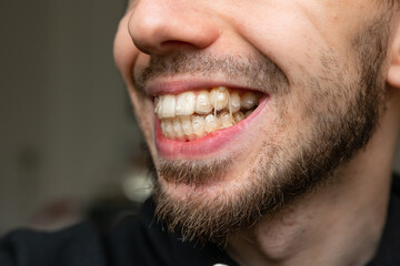 Fototapeta premium unrecognizable dark-haired man with beard with transparent dental retainer