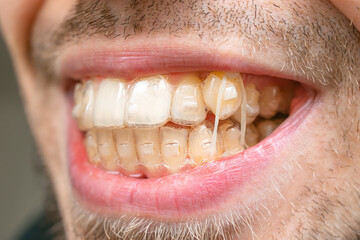 crooked teeth. Crowding of the teeth of the jaw of a young caucasian man