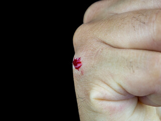 Fototapeta premium Accident open abrasion wound trauma skin hand. People, healthcare and medicine concept. Hand wound on isolated black background.