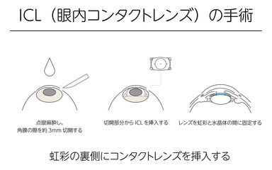 図解、ICL(眼内コンタクトレンズ)による視力矯正、メディカルイラスト