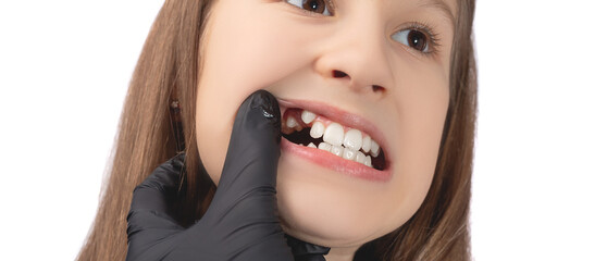 A doctor in black medical gloves examines the oral cavity of a little cute girl. Crooked teeth....