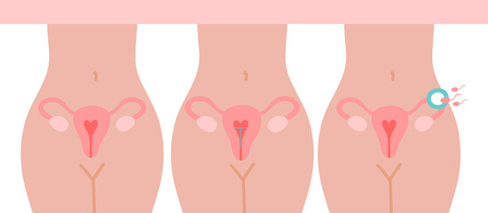 Fertilization icon. Uterus, sperm, insemination. Fertilization in the fallopian tube. The method of IUD contraception is not isolated.