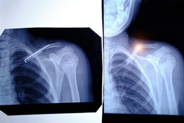 Two X ray images man with fractured collarbone and an inserted space after surgery.