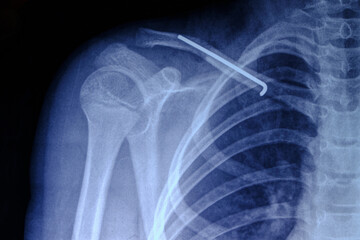 X ray image person with broken collarbone and spoke installed in it after surgery.