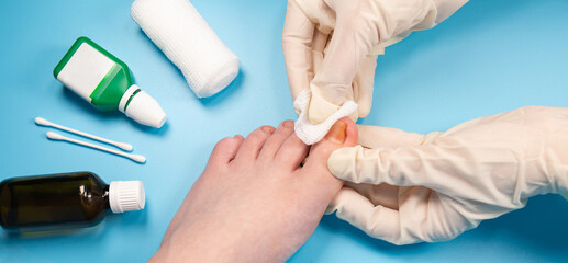 doctor disinfect the injured toenail. Hands in rubber gloves touch injured toenail in clinic. Diagnosis, treatment of mycosis of feet. Podiatrist treating ingrown toenail. Inflammation of the toes - 501940210