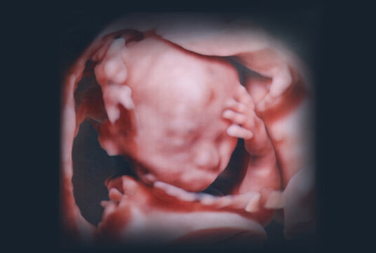 胎児の3D写真