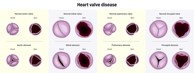 Heart valve disease. Aortic stenosis, Mitral stenosis, Pulmonary stenosis and Tricuspid stenosis.