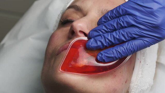 injecting botulinum toxin in the upper lip for lip augmentation