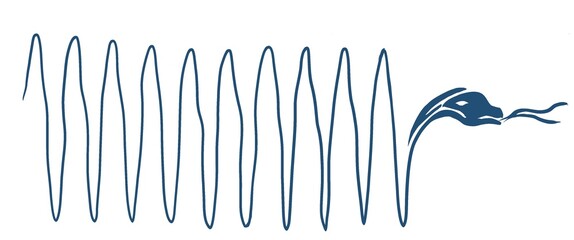 monomorphic ventricular tachycardia findings on electrocardiogram with snake vector illustration - obrazy, fototapety, plakaty