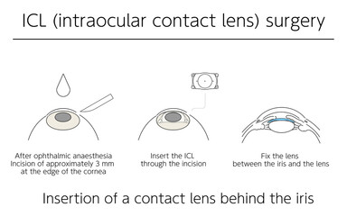 図解、ICL(眼内コンタクトレンズ)による視力矯正、メディカルイラスト - obrazy, fototapety, plakaty