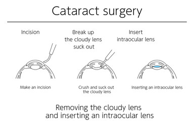 図解、緑内障の手術、メディカルイラスト