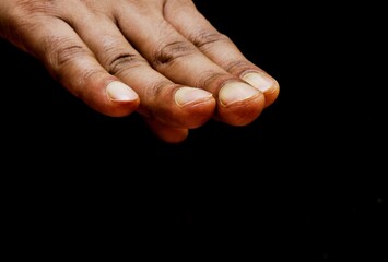 Finger nails of a man having spoon finger or clubbed finger. Clubbed fingers is a symptom of disease, often of the heart or lungs which cause chronically low blood levels of oxygen.  - obrazy, fototapety, plakaty