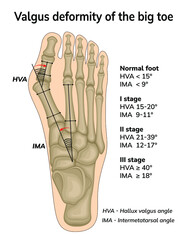 Illustration of valgus deformity of the big toe. The angles of bone displacement during deformation are shown