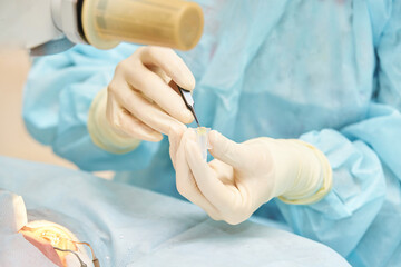 Ophthalmology laser microscope operation. Doctor surgery in clinic. Patient eye treatment. Myopia...