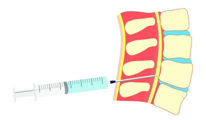 Spinal needle position in a Spinal. Spinal injection with a syringe   - obrazy, fototapety, plakaty