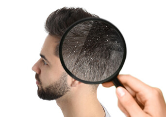 Looking at young man's hair through magnifier on white background. Problem of dandruff - obrazy, fototapety, plakaty