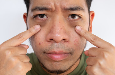 Sleepless Asian man pointing to his under eyes having dark circles with puffiness problem.