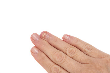 A hand of a woman with one injured nail isolated on white background.