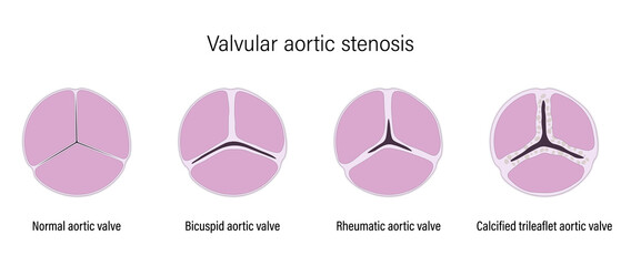 Valvular aortic stenosis. Normal aortic valve, Bicuspid aortic valve, Rheumatic aortic valve and Calcified trileaflet aortic valve.