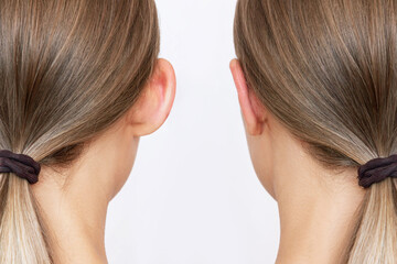 Cropped shot of woman's head with ears before and after otoplasty isolated on a white background. Result of cosmetic plastic surgery of correction auricles and getting rid of lop - eared - obrazy, fototapety, plakaty