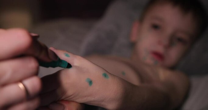 woman on the child's hand puts a dot marker green. baby sick with chickenpox lying on the bed. cure for chickenpox. the acne of chicken pox is clearly visible