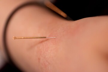 A portrait of a thin acupuncture needle placed below the wrist, put in place by an acupuncturist. This alternative medicine treatment is used for healing, relaxing, stimulation and stress relief.