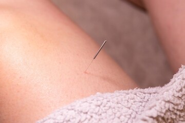 A portrait of a thin acupuncture needle placed on the upper leg, put in place by an acupuncturist....