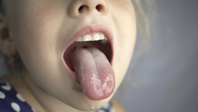 kid salivation girl opens her mouth child shows his teeth soft palate and mouth to dentist. mouth is wide open, tongue is stuck out as far as possible, with clear view of tongue