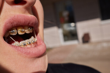 Close up to a young caucasian lady's mouth wearing braces or brackets. Her orthodontic treatment is...