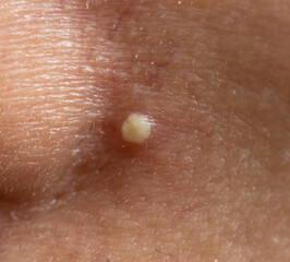 acne on the skin of the face as a background