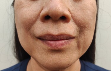 Obraz premium Portrait showing the flabbiness adipose hanging beside the mouth, problem wrinkles and sagging skin of the woman, concept health care.