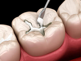 Decayed tooth restoration with composite filling. Dental 3D illustration - 502382289