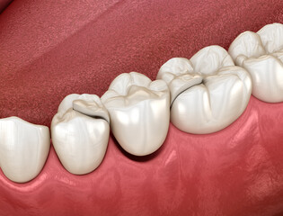 Maryland bridge made from ceramic, premolar tooth recovery. Dental 3D illustration