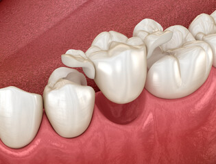 Maryland bridge made from ceramic, premolar tooth recovery. Dental 3D illustration
