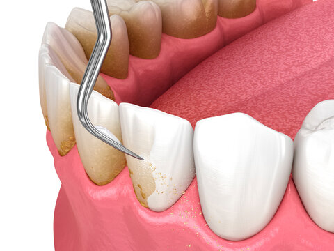 Oral hygiene: Scaling and root planing (conventional periodontal therapy). Dental 3D illustration