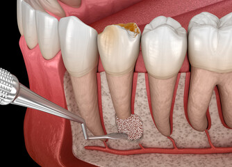 Tooth Cystectomy Surgery - recovery after Periostitis . Dental 3D illustration