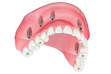 Deurstickers Maxillary prosthesis with gum All on 6 system supported by implants. Dental 3D illustration © Alex Mit