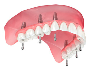 Maxillary prosthesis with gum All on 6 system supported by implants. Dental 3D illustration