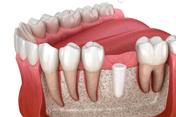 Molar tooth crown installation over ceramic implant. Dental 3D illustration