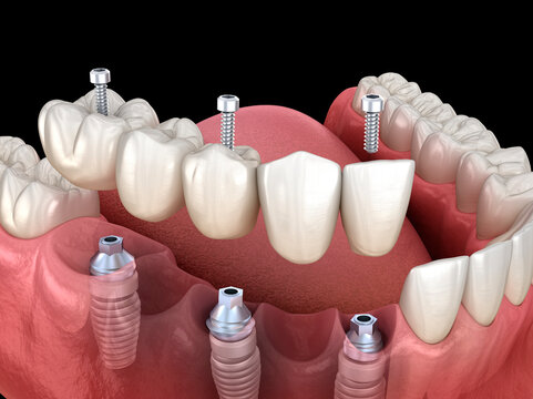 Dental bridge based on 3 implants. Dental 3D illustration