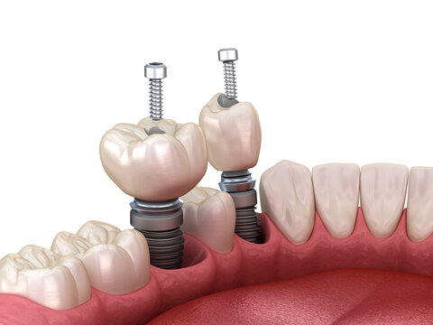 Premolar and Molar tooth crown installation over implant, screw fixation. 3D illustration of dental treatment