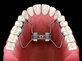 Rapid Palatal Expansion. Dental 3D illustration