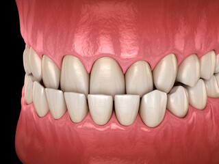 Underbite dental occlusion ( Malocclusion of teeth ). Dental 3D illustration